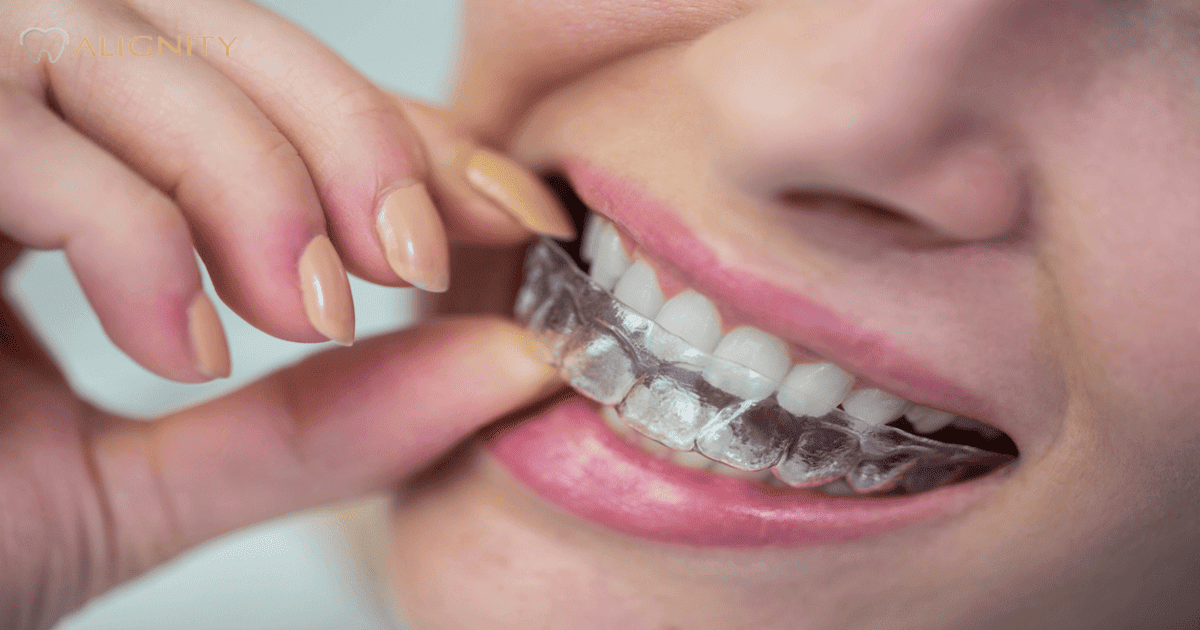 Niềng răng trong suốt là gì?