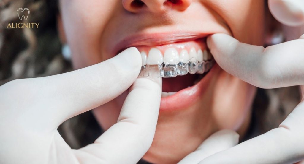 Niềng răng trong suốt là gì? Giá bao nhiêu & Quy trình chuẩn 2026 12 Những lưu ý khi niềng răng trong suốt