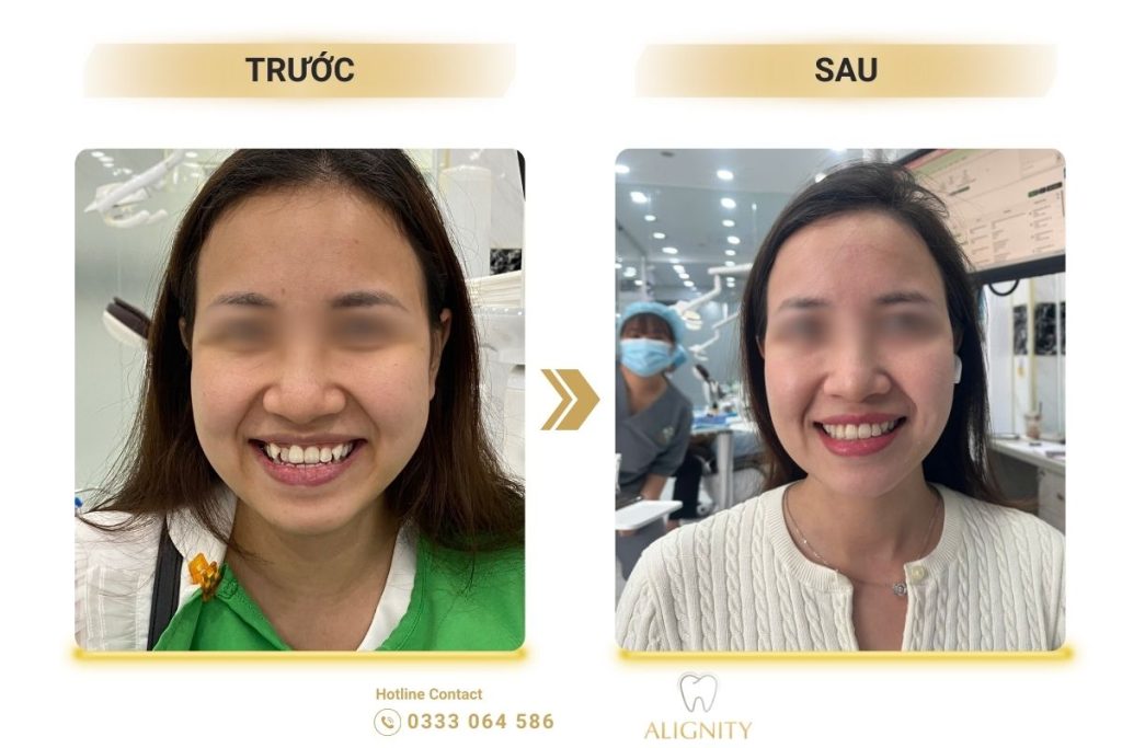 Niềng răng trong suốt là gì? Giá bao nhiêu & Quy trình chuẩn 2026 17 nieng rang trong suot 13 1