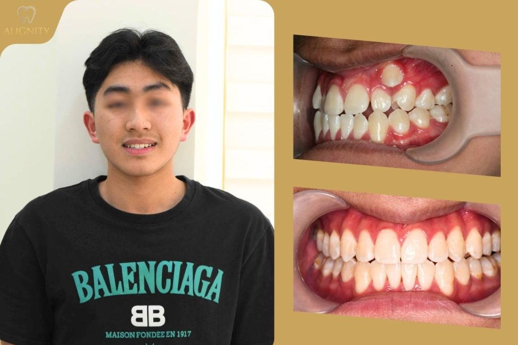 Niềng răng trong suốt là gì? Giá bao nhiêu & Quy trình chuẩn 2026 16 Hình ảnh thực tế một ca niềng răng trong suốt