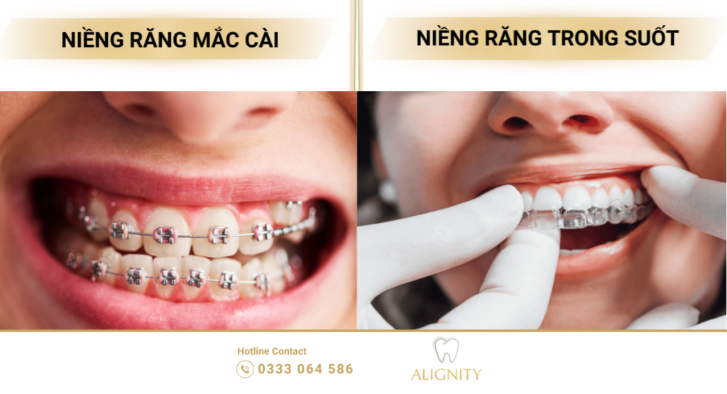 Niềng răng trong suốt là gì? Giá bao nhiêu & Quy trình chuẩn 2026 10 So sánh sự khác nhau giữa niềng răng trong suốt và niềng răng mắc cài