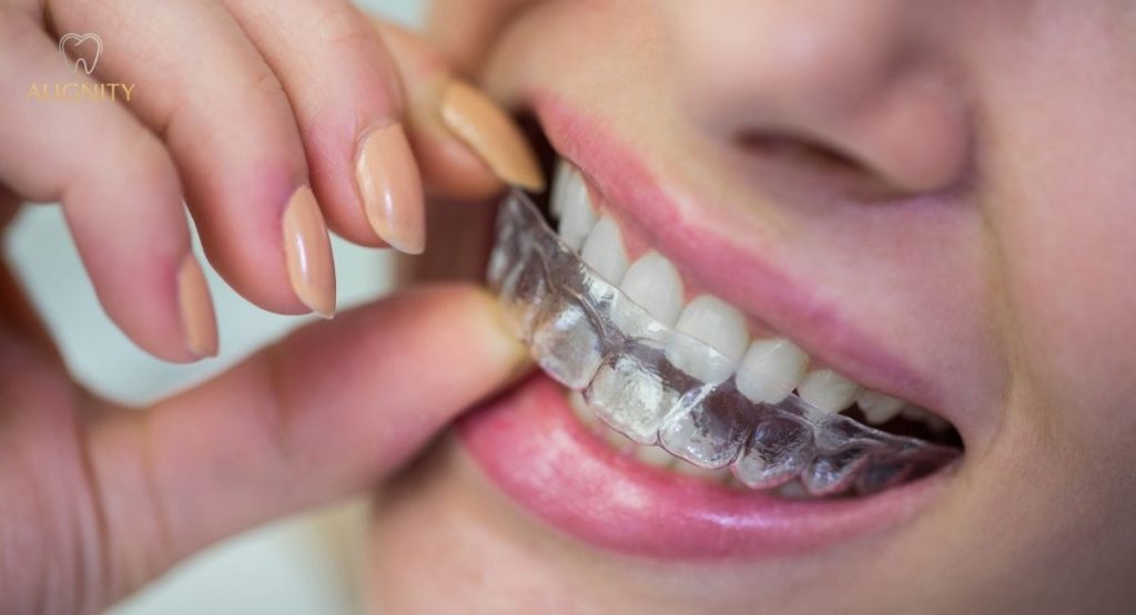 Niềng răng trong suốt là gì? Giá bao nhiêu & Quy trình chuẩn 2026 1 Định nghĩa niềng răng trong suốt là gì