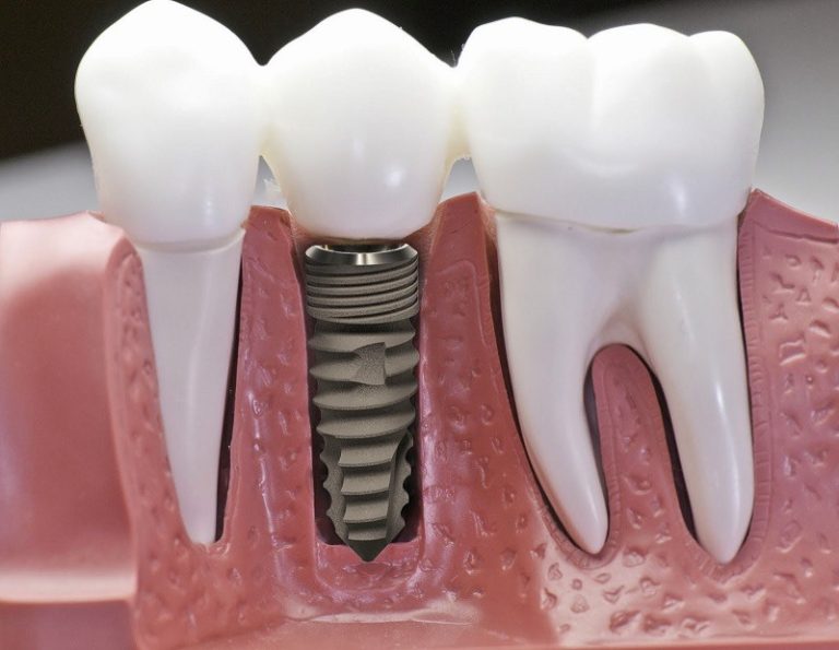 20220427 cay ghep Implant la gi