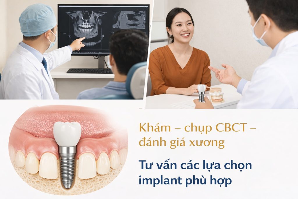 Cay ghep implant b1