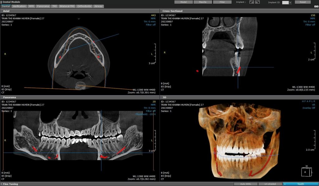 Cay ghep implant b2