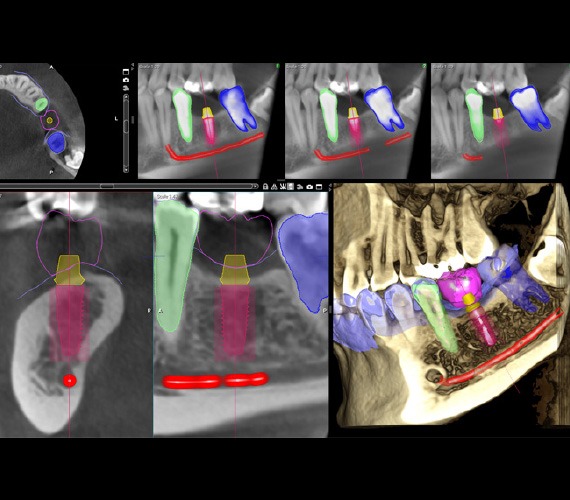 Cay ghep implant b3