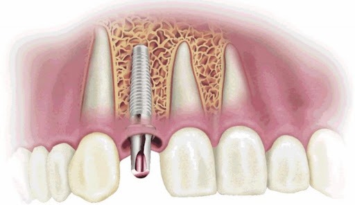 Cay ghep implant b5