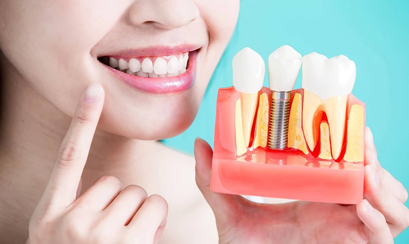 Cay ghep implant b6