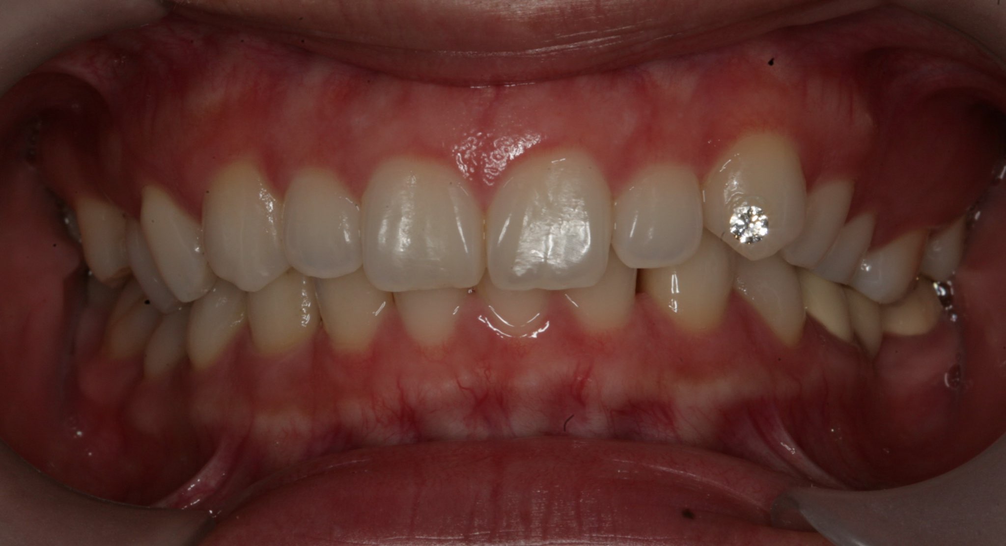 TRƯỚC