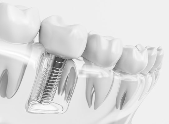 Implant vs Crown Pros Cons 541x4 1