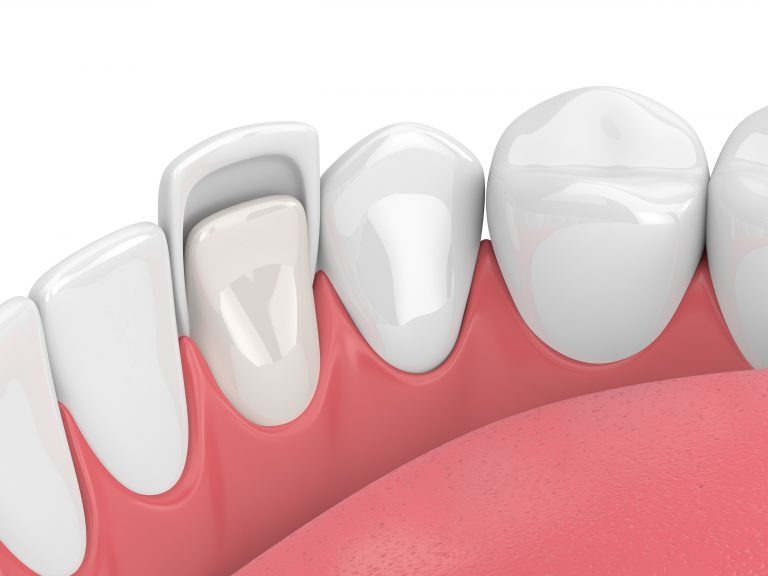 Veneers 768x576 1