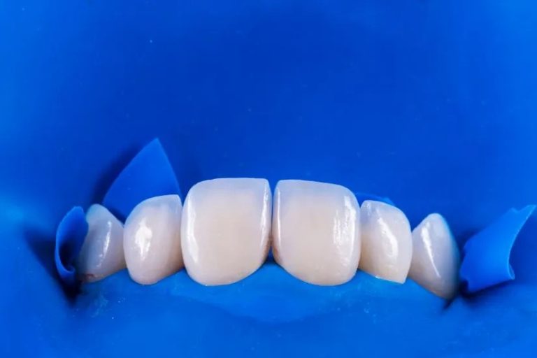 boc rang su veneer 3