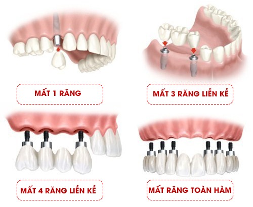 cac truong hop mat rang nen cay