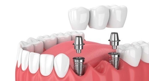 cay ghep implant 1