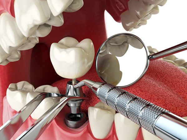 cay ghep implant 2