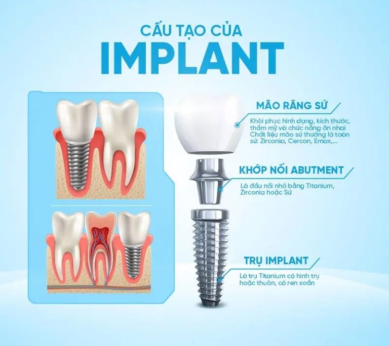 cay ghep implant 3