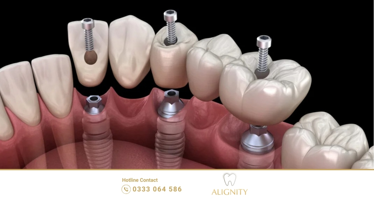 Cấy ghép implant có đau không - hình ảnh mình họa các trụ implant được căm vào nướu răng