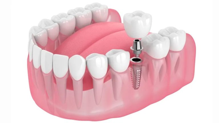 cay ghep rang implant