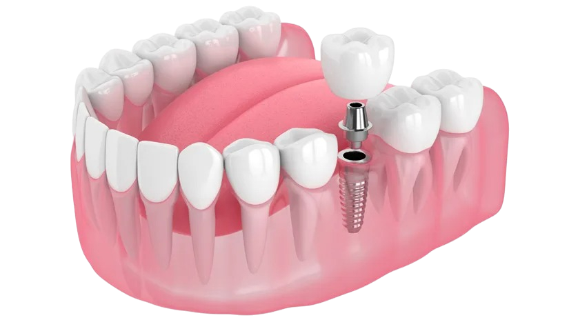 cay ghep rang implant