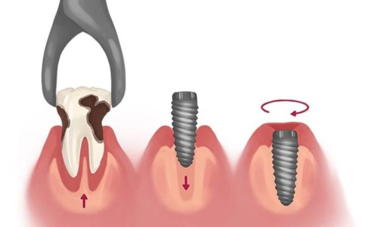 chi phi cay ghep implant tuc thi