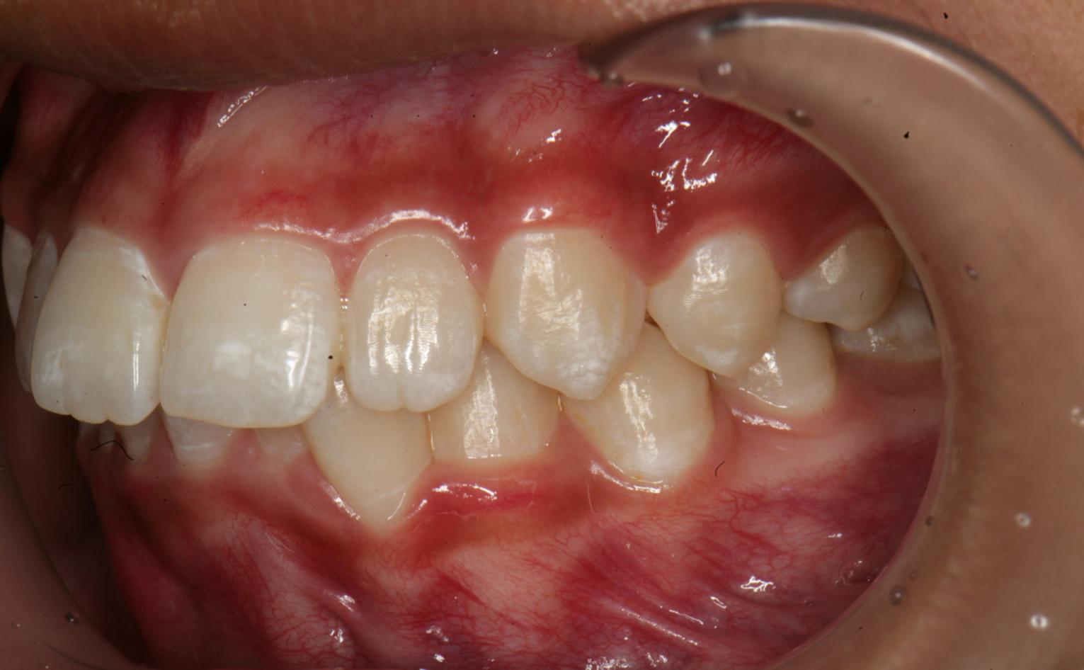 TRƯỚC