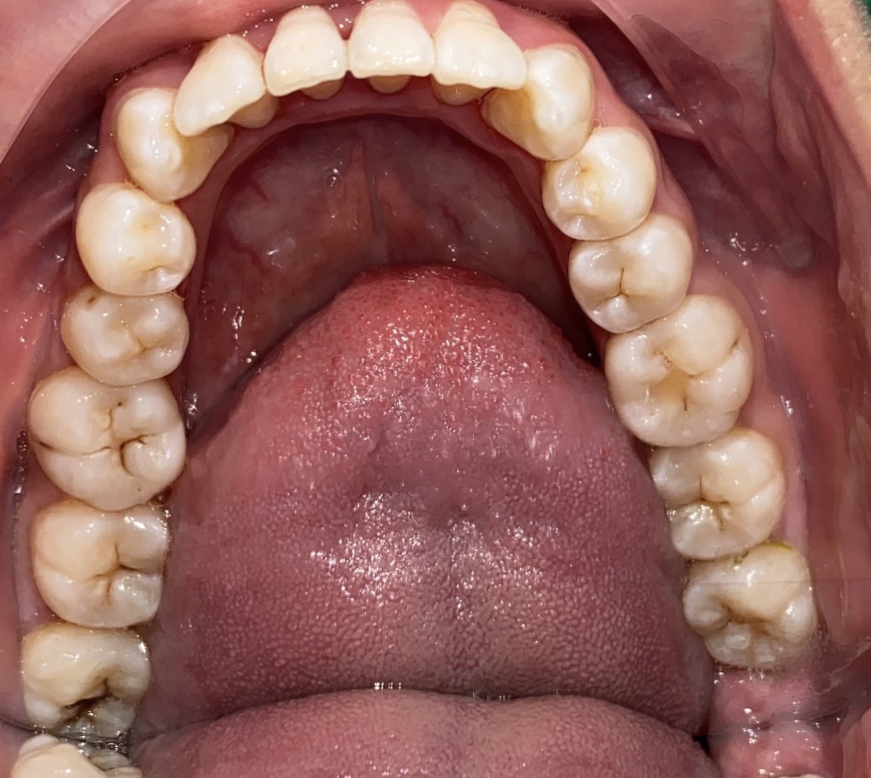 TRƯỚC