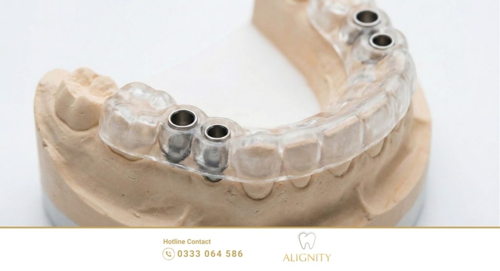 Implant kỹ thuật số: 5 Lợi thế vượt trội so với truyền thống 2 Máng hướng dẫn phẫu thuật in 3D dùng trong cấy ghép implant kỹ thuật số.