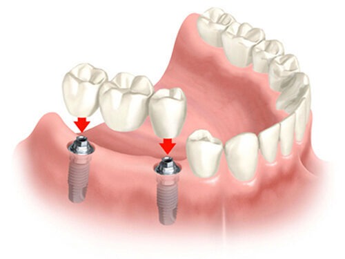 implant la gi