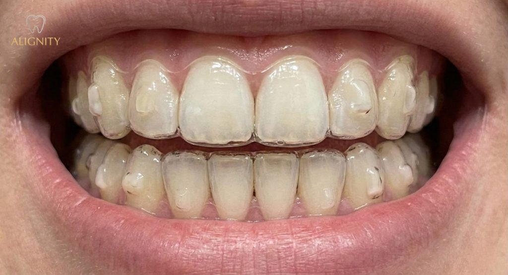 Niềng răng trong suốt cần lưu ý gì? Bí quyết đeo khay & Vệ sinh chuẩn. 3 Cận cảnh hàm răng đang đeo khay niềng trong suốt ôm sát và các nút attachment hỗ trợ di chuyển răng.