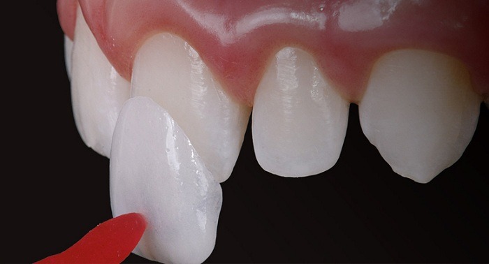 mat dan su veneer 1