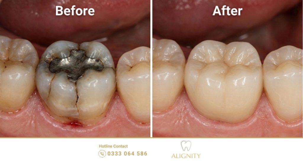 Nên bọc sứ hay dán sứ? Phân tích chi tiết để chọn đúng giải pháp 1 nen boc su hay dan su 4 1