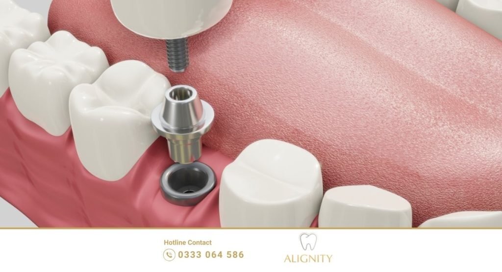 Nha khoa ALIGNITY Cần Thơ: Tiên phong niềng răng trong suốt & implant kỹ thuật số 6 Cấy ghép Implant kỹ thuật số