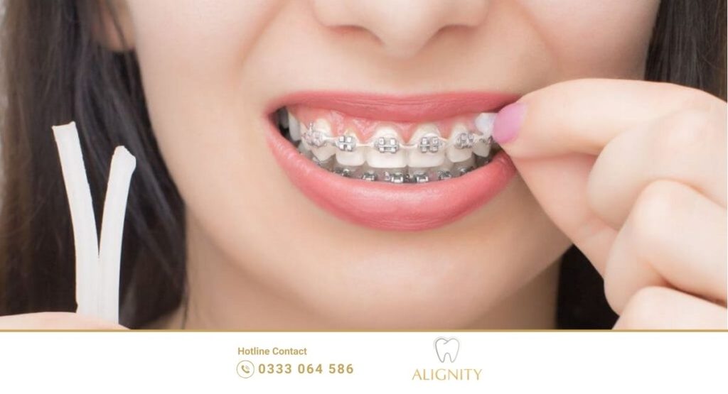 Niềng răng có đau không? Giai đoạn nào đau nhất 4 Sáp nha khoa bôi lên mắc cài để giảm đau và tránh trầy xước môi má.