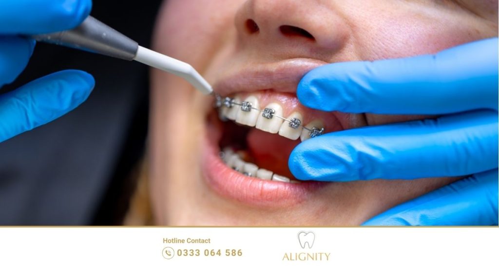 Niềng răng có đau không? Giai đoạn nào đau nhất 1 Cận cảnh bác sĩ thực hiện gắn mắc cài kim loại và đi dây cung lên răng.