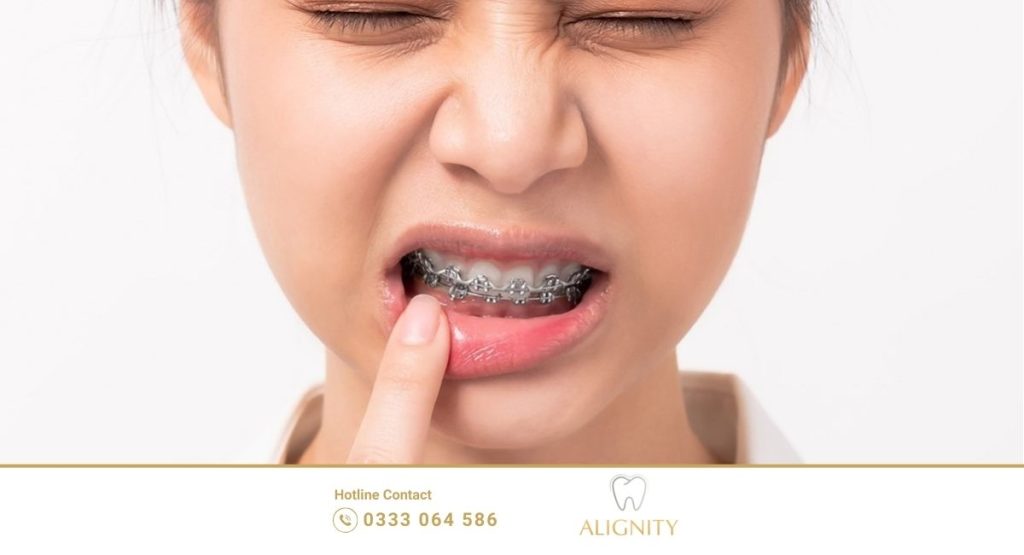 Niềng răng có đau không? Giai đoạn nào đau nhất 7 Biểu cảm đau nhức, ê buốt răng thường gặp trong 2-3 ngày đầu mới niềng.