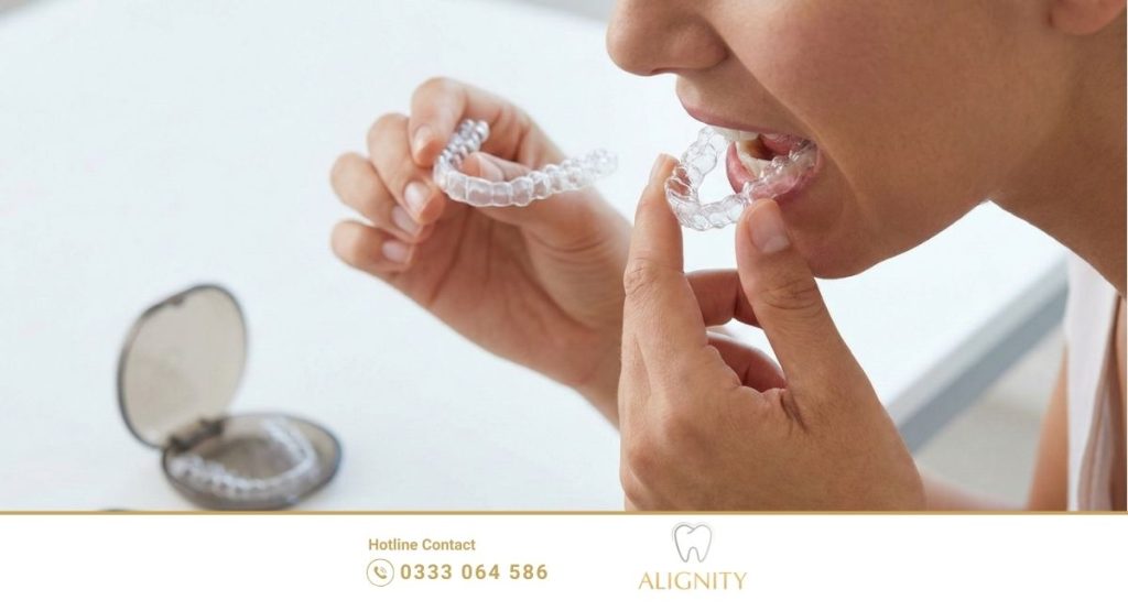 Niềng răng trong suốt mất bao lâu? Nhanh hơn mắc cài không 3 Hướng dẫn cách đeo khay niềng răng trong suốt đúng cách và tuân thủ thời gian đeo 22 giờ mỗi ngày.
