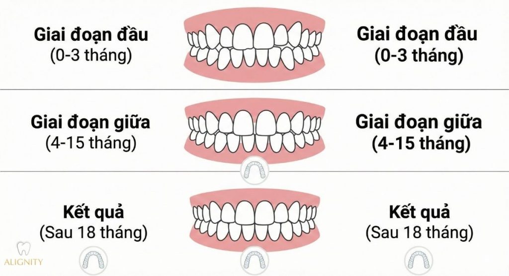 Niềng răng trong suốt mất bao lâu? Nhanh hơn mắc cài không 4 Biểu đồ mô phỏng quá trình thay đổi vị trí răng qua 3 giai đoạn niềng răng trong suốt từ 0 đến 18 tháng.