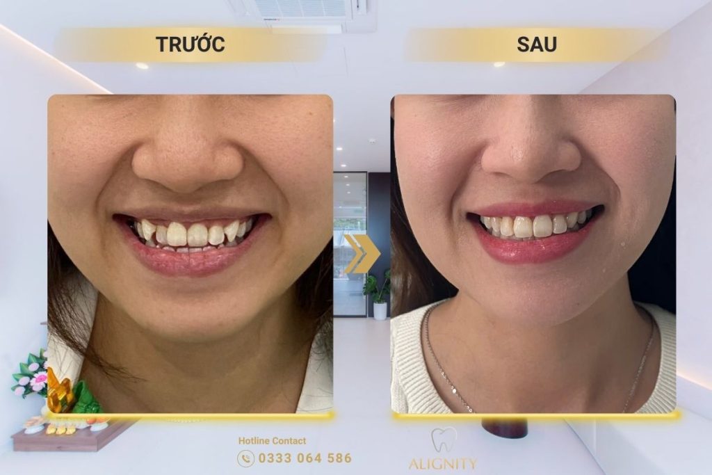 Niềng răng trong suốt mất bao lâu? Nhanh hơn mắc cài không 5 Hình ảnh thực tế so sánh trước và sau khi niềng răng trong suốt cho trường hợp răng lệch và khấp khểnh.