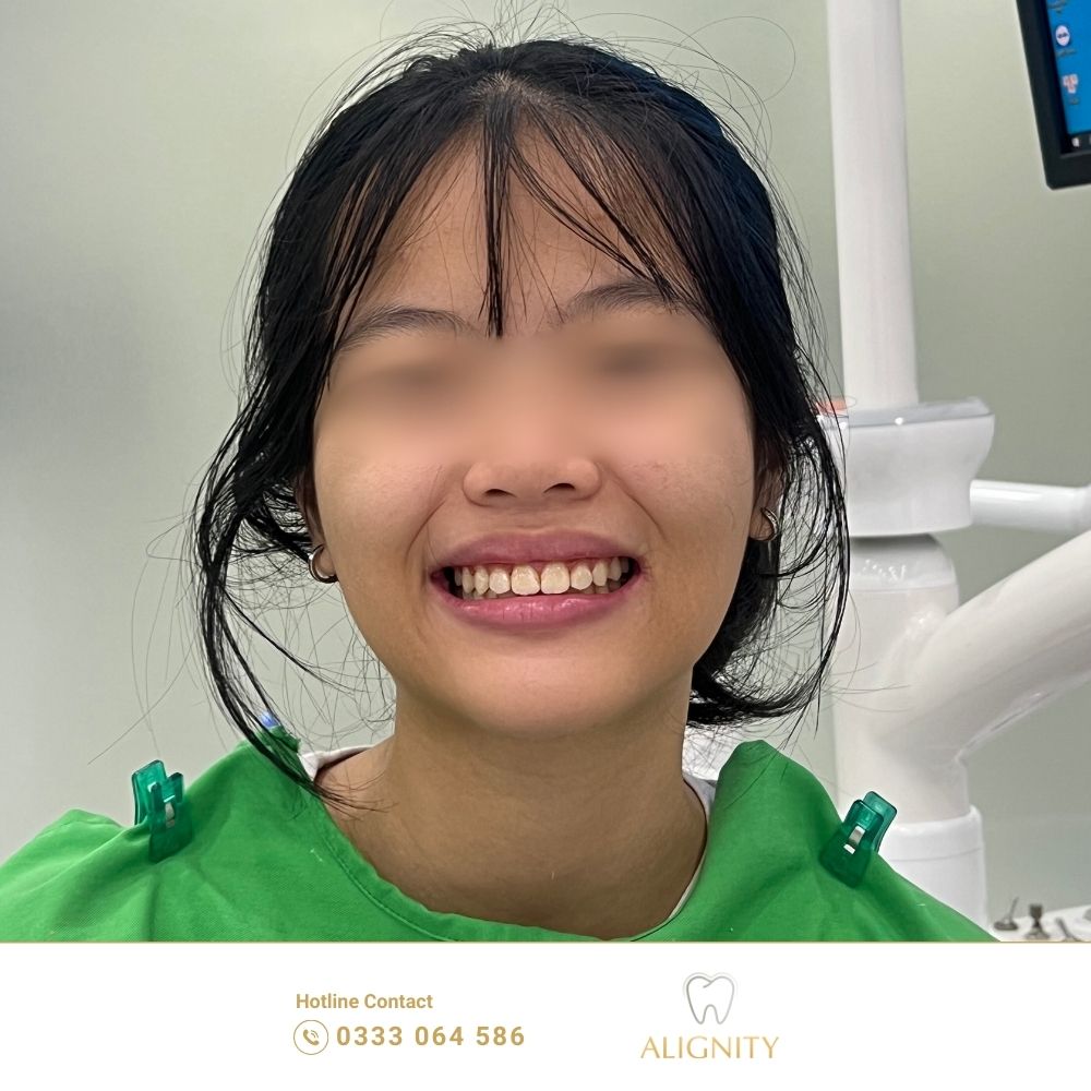 Lệch khớp cắn là gì? Nguyên nhân, tác hại và giải pháp điều trị 8 Hình ảnh sau khi điều trị