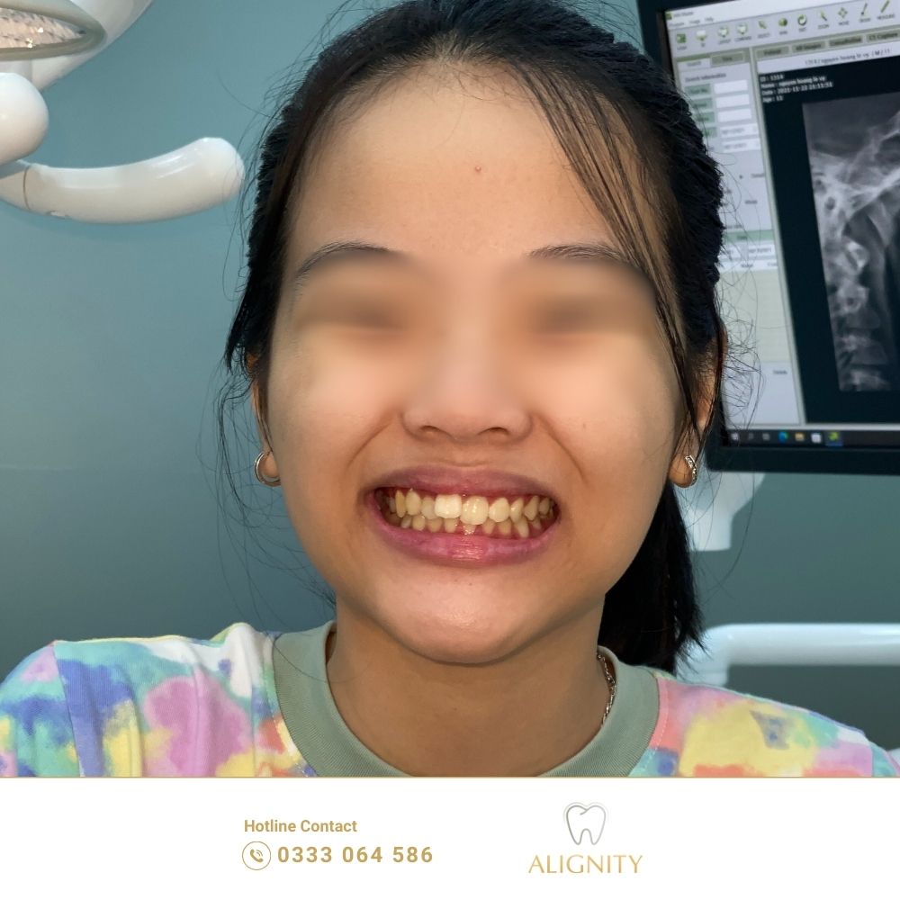 Lệch khớp cắn là gì? Nguyên nhân, tác hại và giải pháp điều trị 7 Hình ảnh trước khi điều trị