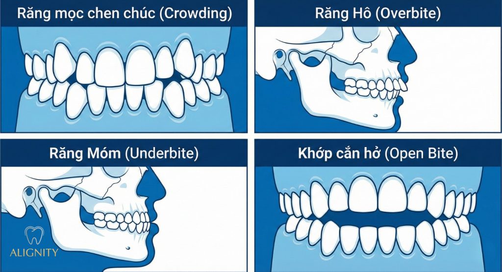 Các dạng sai lệch răng phổ biến: Hô, móm, lệch hàm, chen chúc & cách điều trị 1 Các dạng sai lệch răng phổ biến - Phân biệt răng hô móm răng chen chúc và khớp cắn hở