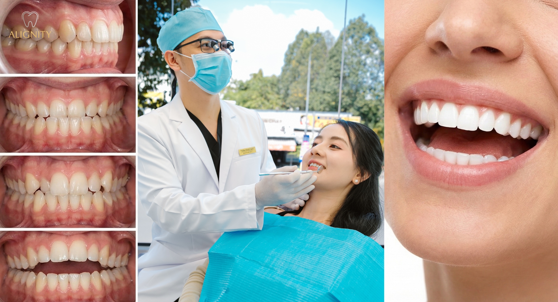 Các dạng sai lệch răng phổ biến hô móm lệch hàm và cách điều trị