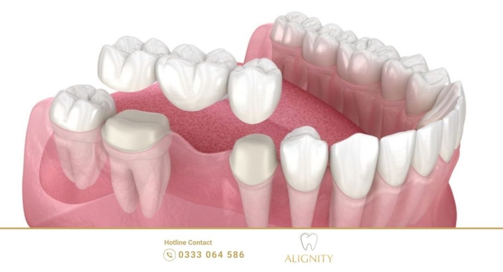So sánh cầu implant và răng sứ : Giải pháp nào tối ưu nhất hiện nay? 2 Mô phỏng kỹ thuật bắc cầu răng sứ phải mài nhỏ hai răng thật bên cạnh để làm trụ đỡ.