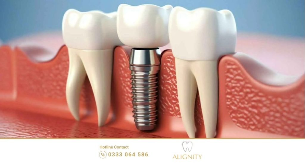 So sánh cầu implant và răng sứ : Giải pháp nào tối ưu nhất hiện nay? 1 Cấu tạo răng Implant với trụ Titanium cấy ghép độc lập vào xương hàm thay thế chân răng thật.