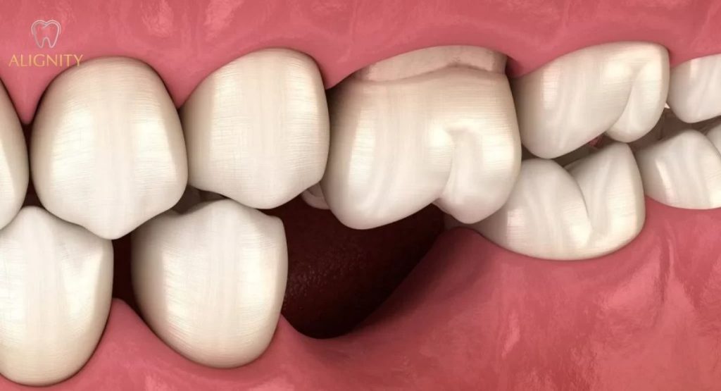 So sánh cầu implant và răng sứ : Giải pháp nào tối ưu nhất hiện nay? 4 Hình ảnh minh họa hiện tượng tiêu xương hàm và tụt nướu nghiêm trọng tại vị trí mất răng lâu ngày.