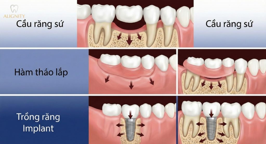 Tiêu xương hàm là gì? Vì sao cần làm Implant sớm để ngừa lão hóa? 3 So sánh tác động lên xương hàm của cầu răng sứ, hàm tháo lắp (gây tiêu xương hàm) và Implant