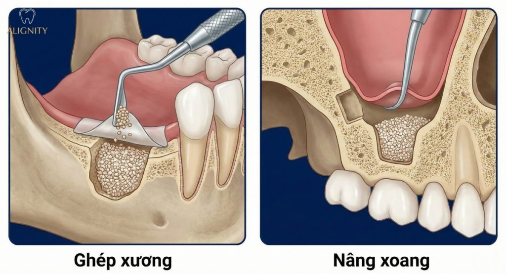 Tiêu xương hàm là gì? Vì sao cần làm Implant sớm để ngừa lão hóa? 6 Mô phỏng kỹ thuật ghép xương và nâng xoang để tạo đủ thể tích xương cho việc cấy ghép Implant.