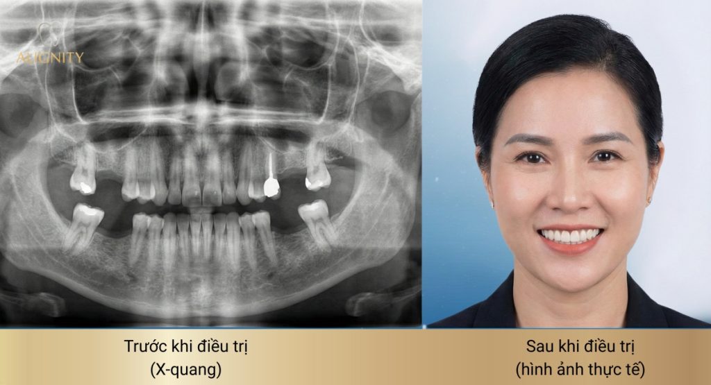 Tiêu xương hàm là gì? Vì sao cần làm Implant sớm để ngừa lão hóa? 10 Hình ảnh thực tế khách hàng trồng răng Implant thành công sau khi bị tiêu xương hàm.