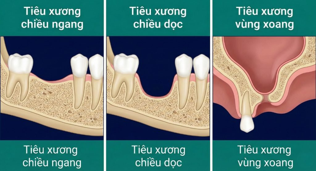 Tiêu xương hàm là gì? Vì sao cần làm Implant sớm để ngừa lão hóa? 4 Các dạng tiêu xương hàm phổ biến: tiêu chiều ngang, tiêu chiều dọc và sa xoang hàm trên.