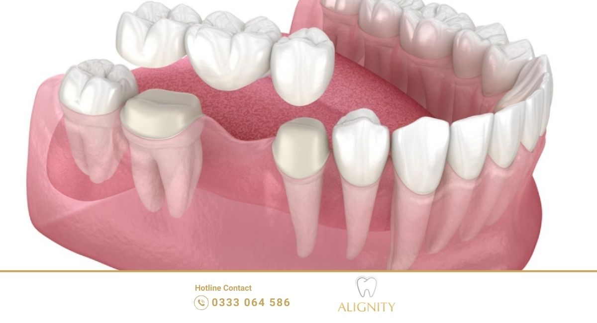 Trồng răng implant - Cầu răng sứ là gì